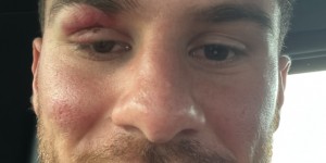 【龙八国际】痛并快乐着！麦卡利斯特封堵马尔穆什射门后“破相”，但心情不错