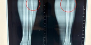 【龙八国际】伤情报告：王刚左小腿中上段腓骨裂纹骨折