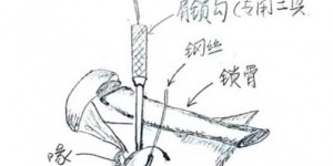【龙八国际】主刀医生：朱辰杰手术很成功 高强度人工韧带可承受200公斤冲撞力