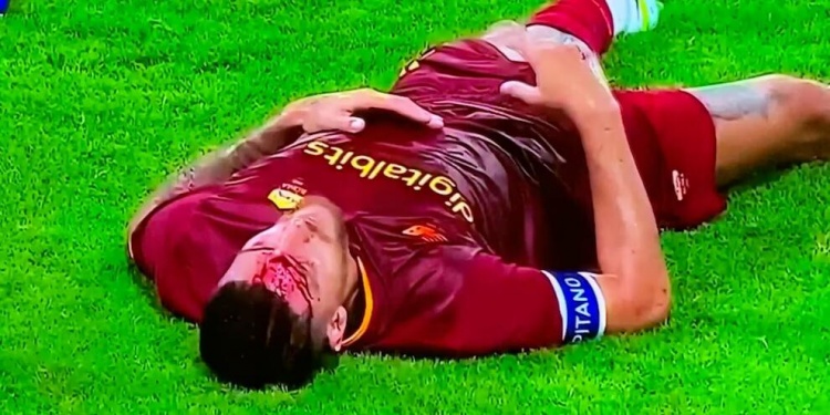 罗体:罗马队长佩莱格里尼被肘击后眉骨受伤流血不止,需要缝4针