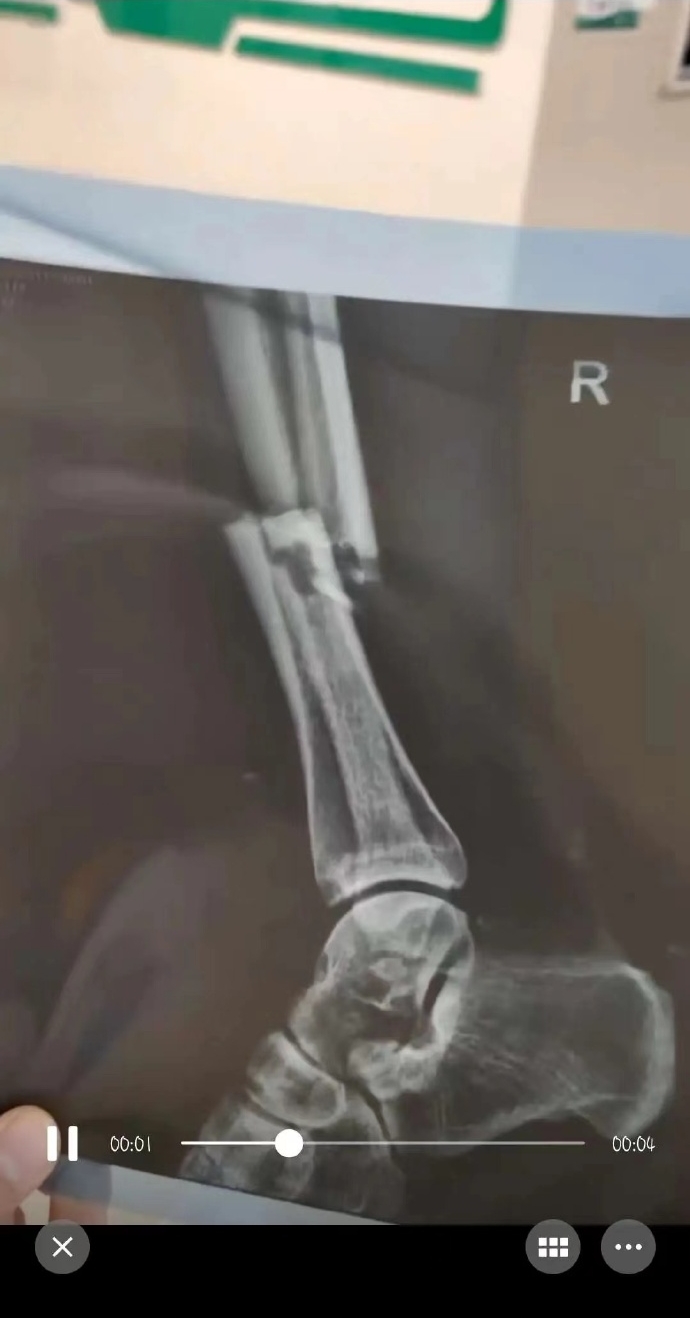 断腿?网传广州队前锋帕尔曼江参加阿图什杯时,遭小腿骨折重伤