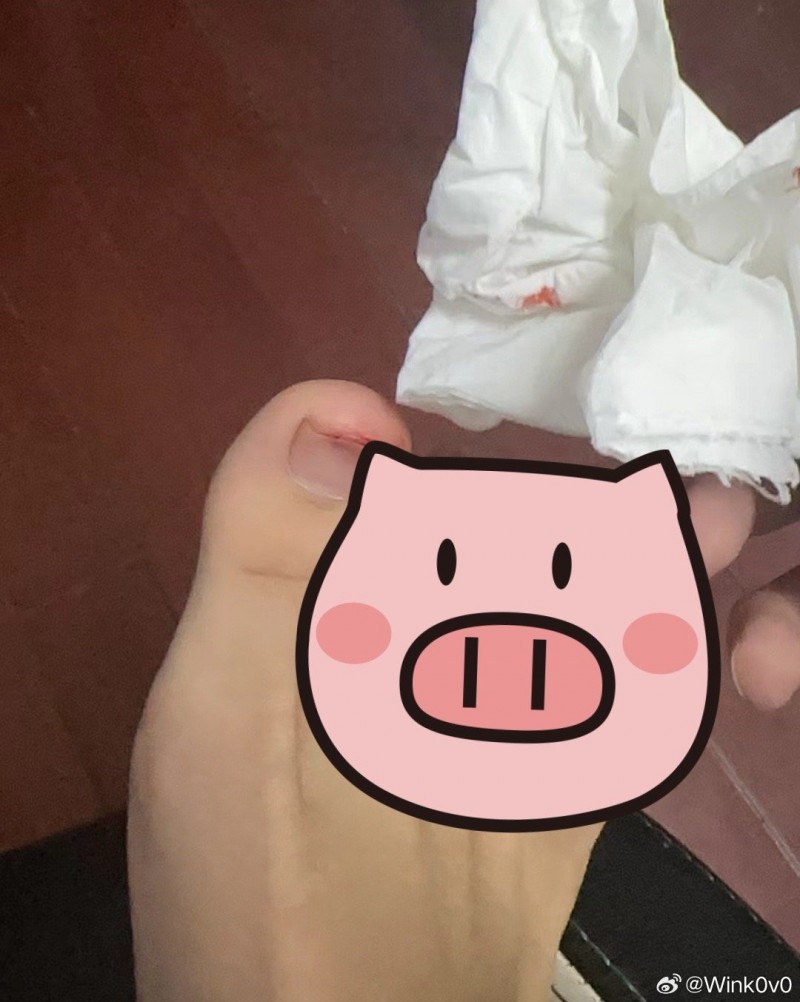 iG俱乐部辅助Wink:兄弟们关门要小心,刚才夹伤右脚大拇指了